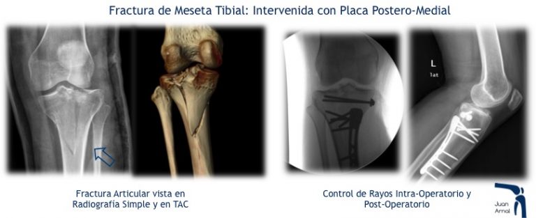 juan arnal, traumatologo, madrid, rotura, fractura, cirugia, deporte, recuperacion, operacion,