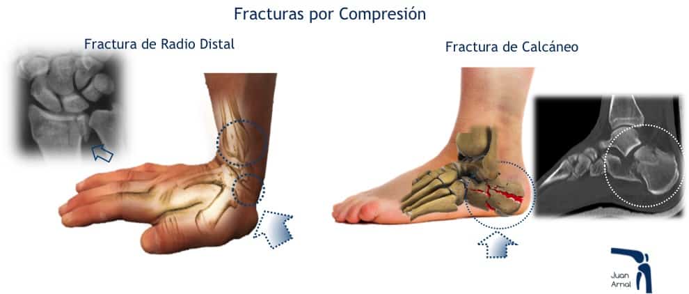 juan arnal, traumatologo, madrid, fracturas, futbol, deporte, esqui, operar, fractura meseta tibial, fractura, fractura tobillo, esguince tobillo, fractura mano, fractura pie, fractura calcaneo, mecanismo fractura,