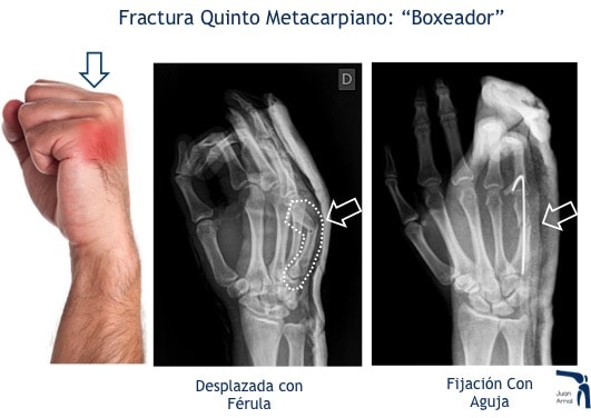juan arnal, traumatologo, madrid, rotura, fractura, cirugia, deporte, recuperacion, operacion,