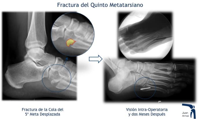 juan arnal, traumatologo, madrid, rotura, fractura, cirugia, deporte, recuperacion, operacion,