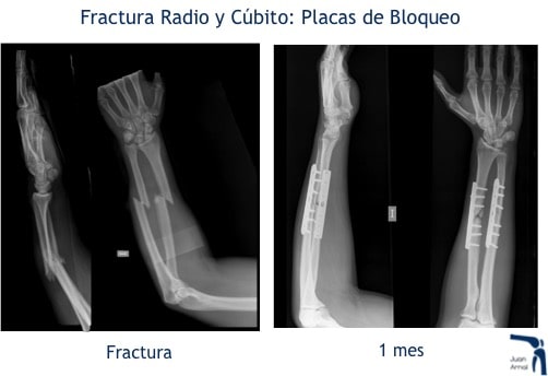juan arnal, traumatologo, madrid, rotura, fractura, cirugia, deporte, recuperacion, operacion,