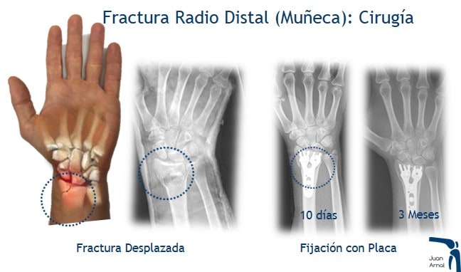 juan arnal, muñeca, traumatologo, madrid, cirugia, placa muñeca, radio