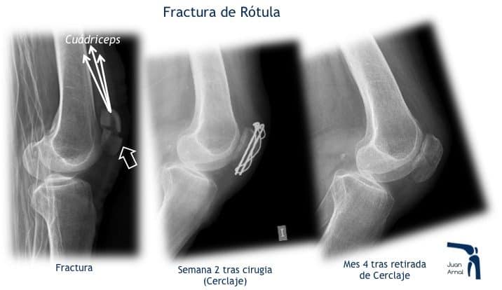 juan arnal, traumatologo, madrid, rotura, fractura, cirugia, deporte, recuperacion, operacion,