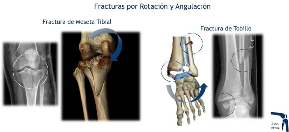 juan arnal, traumatologo, madrid, fracturas, futbol, deporte, esqui, operar, fractura meseta tibial, fractura, fractura tobillo, esguince tobillo, fractura mano, fractura pie, fractura calcaneo, mecanismo fractura,