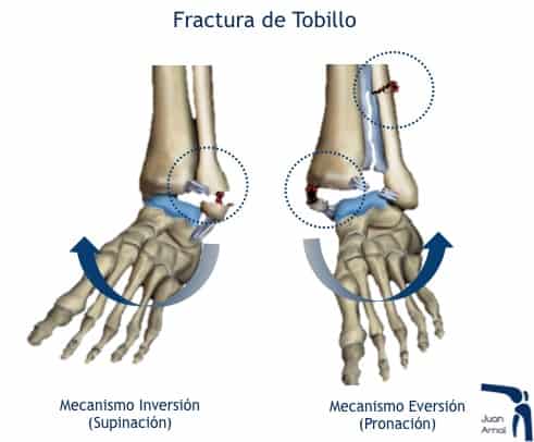 juan arnal, traumatologo, madrid, rotura, fractura, cirugia, deporte, recuperacion, operacion,