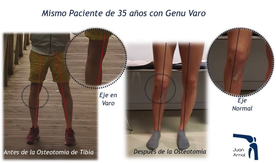 juan arnal, traumatologo, dolor rodilla, piernas desviadas, piernas en c, piernas en circula, rodillas circulares, genu varo, osteotomía tibia, corrección piernas, piernas torcidas, cirugía, adeslas, asisa, cirujano rodilla, traumatologo deportivo