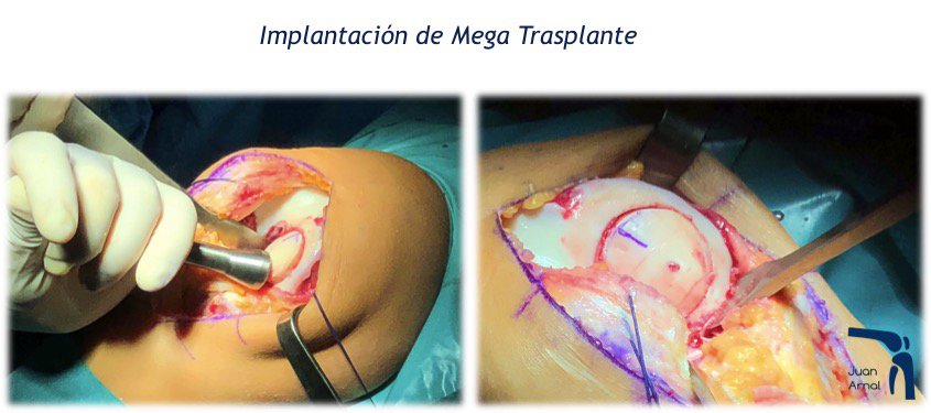 mega transplante, transplante rodilla, mega oats, cartilago transplante rodilla