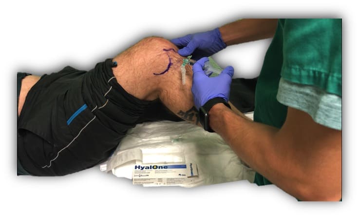 Acido hialuronico, rodilla, cadera, infiltración, hialurónico, lubricar, dolor rodilla, condromalacia, osteocondritis, infiltración rodilla, pinchazo rodilla, prp, células madre, lesión cartílago, ulcera, cartílago, juan arnal, traumatologo, meniscos, rotura menisco, artroscopia rodilla, tobillo, artrosis rodilla, adeslas, asisa, cirujano rodilla, traumatologo deportivo