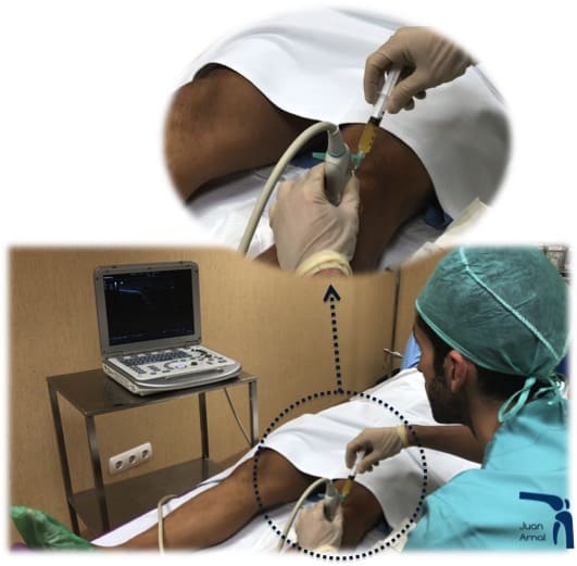 prp, factores crecimiento, plasma, plaquetas, células madre, tendón, Aquiles, rotuliano, supraespinoso, tendinitis, epicondilitis, codo tenista, curación, dolor, células sangre, terapia biológica, traumatología deportiva, infiltración, ecografía, juan arnal, madrid, deporte, recuperación, rotura muscular, vuelta al deporte, correr, lesion,