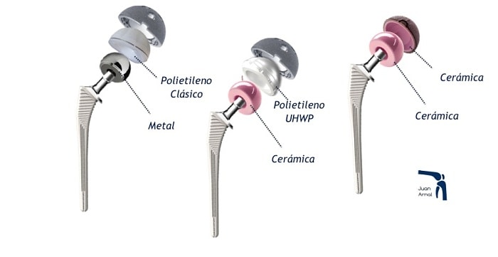 polietileno, ceramica, nuevas prótesis cadera, protesis de cadera, artrosis cadera,traumatologo, juan arnal, madrid, adeslas, mapfre, privado, cirujano cadera