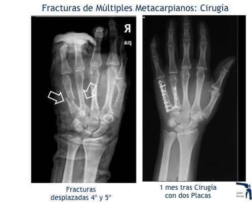 juan arnal, traumatologo, madrid, rotura, fractura, cirugia, deporte, recuperacion, operacion,