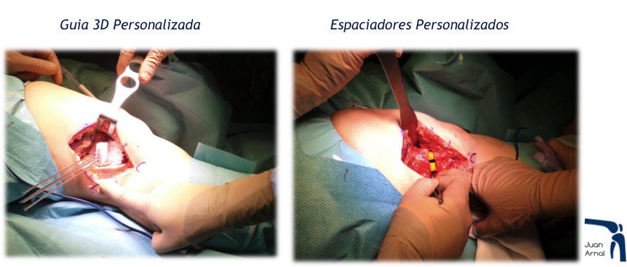 genu varo, genu valgo, piernas torcidas, cirugia, artrosis, rodilla, piernas circulo, tres dimensiones, corrección, osteotomia rodilla, corte hueso, traumatologo, dolor rodilla, piernas desviadas, piernas en c, piernas en circula, rodillas circulares, genu varo, osteotomía tibia, corrección piernas, piernas torcidas, cirugía, adeslas, asisa, cirujano rodilla, traumatologo deportivo