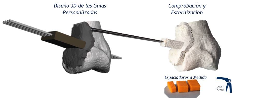 genu varo, genu valgo, piernas torcidas, cirugia, artrosis, rodilla, piernas circulo, tres dimensiones, corrección, osteotomia rodilla, corte hueso, traumatologo, dolor rodilla, piernas desviadas, piernas en c, piernas en circula, rodillas circulares, genu varo, osteotomía tibia, corrección piernas, piernas torcidas, cirugía, adeslas, asisa, cirujano rodilla, traumatologo deportivo