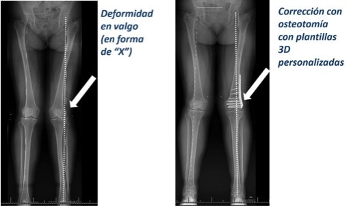 juan arnal, traumatologo, dolor rodilla, piernas desviadas, piernas en c, piernas en circula, rodillas circulares, genu varo, osteotomía tibia, corrección piernas, piernas torcidas, cirugía, adeslas, asisa, cirujano rodilla, traumatologo deportivo