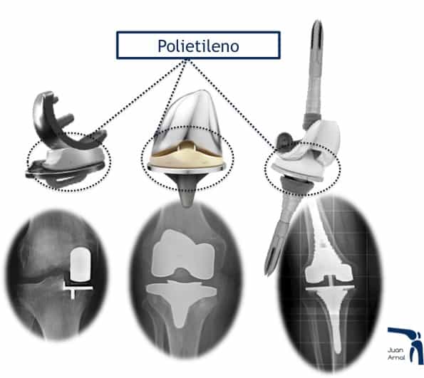 modelos, cirugía artrosis rodilla, prótesis parcial rodilla, nuevo modelo prótesis rodilla, prótesis mínima rodilla, mínima cicatriza, unicompartimental, sustitución rodilla, cambiar rodilla, protesis rodilla, cirujano rodilla, artrosis, dolor rodilla, mejor cirujano rodilla, madrid, artrosis, condromalacia, traumatologo,