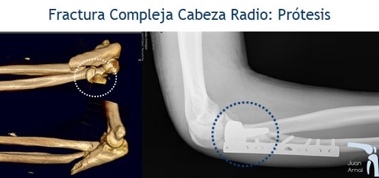 juan arnal, traumatologo, madrid, fractura, codo, cabeza radio, protesis, codo