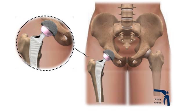 cirujano cadera, artrosis de cadera, coxartrosis, cadera gastada, dolor ingle, no poder cruzar piernas, factores de crecimiento, cirujano Madrid, privado, traumatologo, madrid, dolor rodilla, dolor muslo, dolor femur, protesis cadera, protesis total, salvar cadera, juan arnal, operación cadera, cirugía, muletas