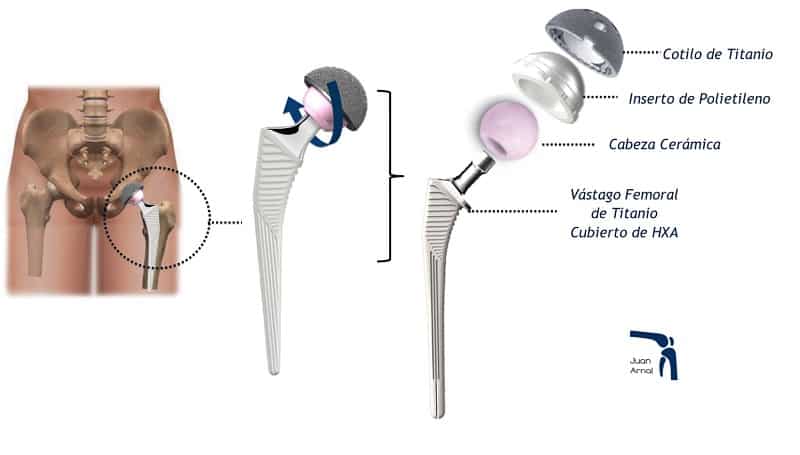 cirujano cadera, artrosis de cadera, coxartrosis, cadera gastada, dolor ingle, no poder cruzar piernas, factores de crecimiento, cirujano Madrid, privado, traumatologo, madrid, dolor rodilla, dolor muslo, dolor femur, protesis cadera, protesis total, salvar cadera, juan arnal, operación cadera, cirugía, muletas