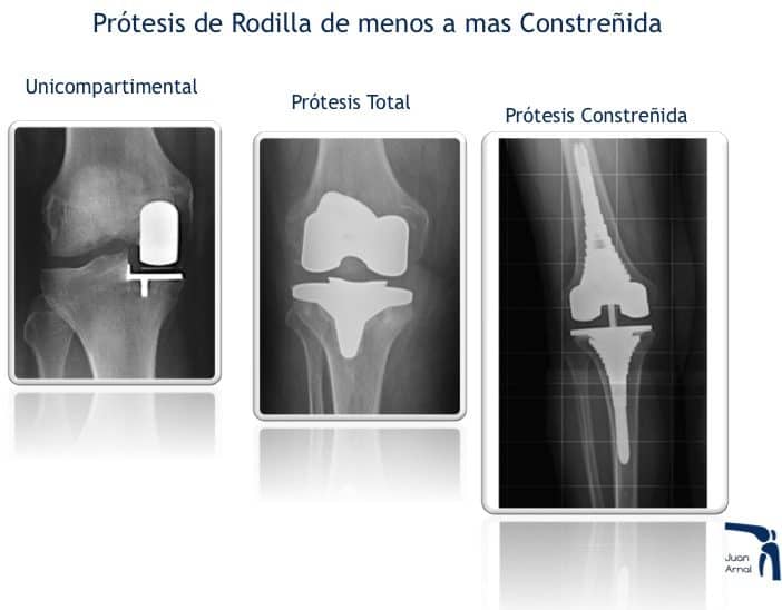 modelos, cirugía artrosis rodilla, prótesis parcial rodilla, nuevo modelo prótesis rodilla, prótesis mínima rodilla, mínima cicatriza, unicompartimental, sustitución rodilla, cambiar rodilla, protesis rodilla, cirujano rodilla, artrosis, dolor rodilla, mejor cirujano rodilla, madrid, artrosis, condromalacia, traumatologo,