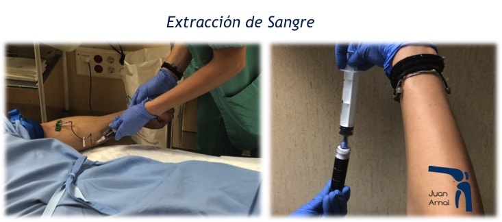 prp, factores crecimiento, plasma, plaquetas, células madre, tendón, Aquiles, rotuliano, supraespinoso, tendinitis, epicondilitis, codo tenista, curación, dolor, células sangre, terapia biológica, traumatología deportiva, infiltración, ecografía, juan arnal, madrid, deporte, recuperación, rotura muscular, vuelta al deporte, correr, lesion,