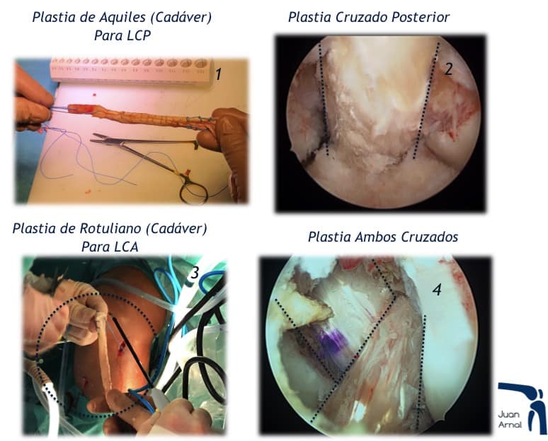 plastias, reconstrucción, cirugia, lesión múltiple,juan arnal, cirujano rodilla, rotura multiples ligamentos, luxación rodilla, rotura cruzado anterior, rotura cruzado posterior, ligamento lateral interno, rotura lateral interno, ligamento medial, esguice lateral interno, esguince rodilla, artrosis rodilla, plastia lateral interno, lesión varios ligamentos rodilla, cirujano Madrid, privado, traumatologo, madrid, dolor rodilla, condromalacia, dolor rotula, correr, running, sentadilla, crossfit, musculación, artrosis de rodilla, genu varo, factores de crecimiento, cirugía, plastia