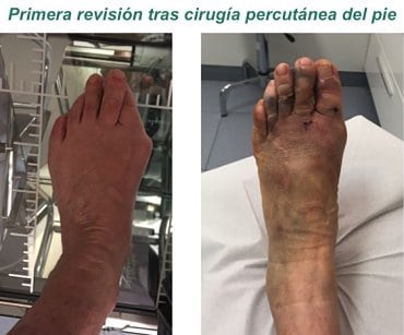 Primera revisión tras cirugía percutánea del pie