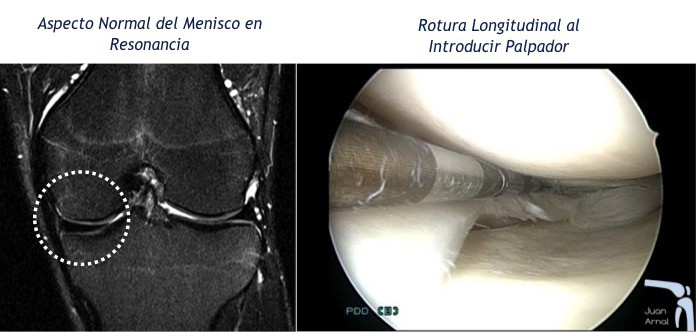 juan arnal, traumatologo, dolor rodilla, rotura asa de cubo, rotura cuerno posterior, roto menisco, rotura menisco, ligamento cruzado anterior, artroscopia rodilla, sutura menisco, adeslas, asisa, cirujano rodilla, traumatologo deportivo
