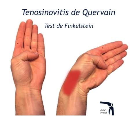tendinitis mano, traumatologo, madrid, juan arnal, dolor muñeca