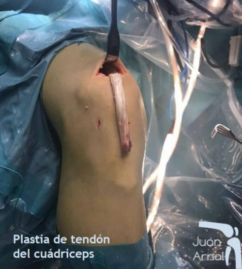 juan arnal, traumatologo, meniscos, rotura menisco, ligamento cruzado anterior, rotura cruzado anterior, ligamento cruzado posterior, plastia cruzado, hth, isquios, semitendinoso, recuperación, cirugía, artroscopia rodilla, tobillo, artrosis rodilla, adeslas, asisa, cirujano rodilla, traumatologo deportivo